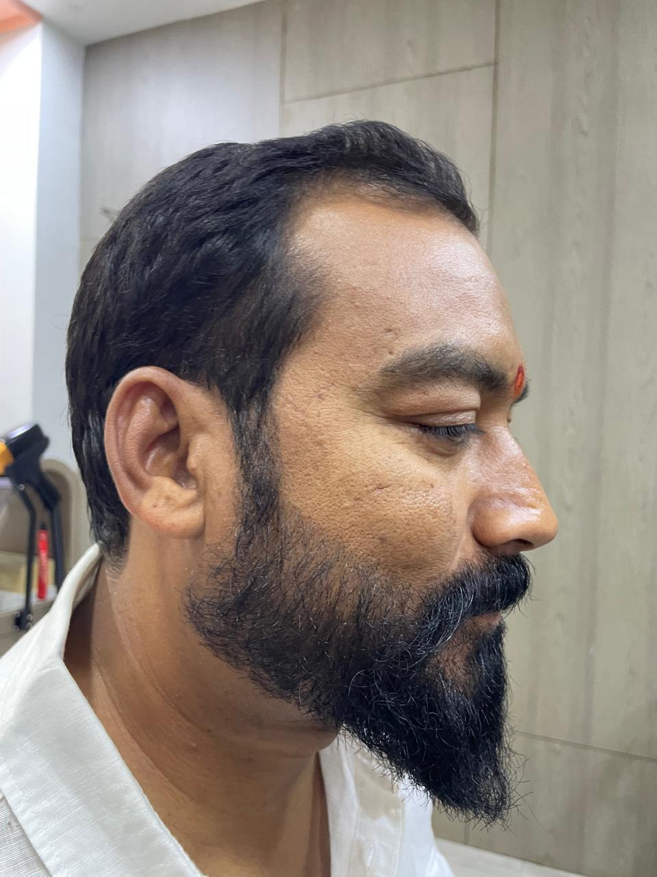 After - Pigment Laser